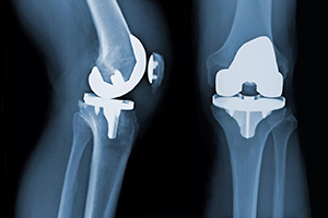 knee replacement x-ray